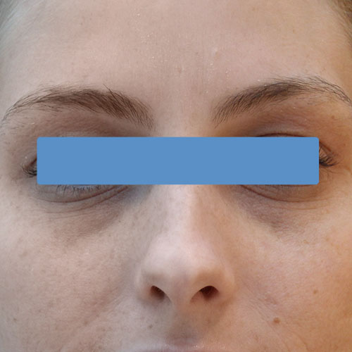 CoolBleph bevor https://asclepion.com/cooltreatments/