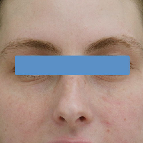 CoolBleph danach https://asclepion.com/cooltreatments/