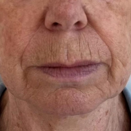 CoolOra bevor https://asclepion.com/cooltreatments/