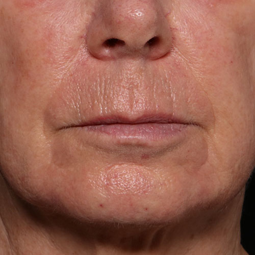 CoolOra danach https://asclepion.com/cooltreatments/