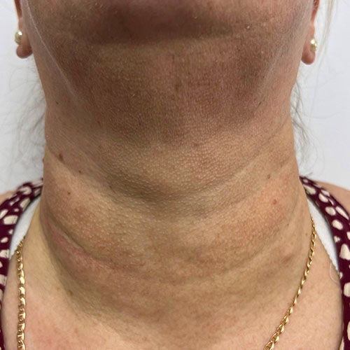 CoolVive danach https://asclepion.com/cooltreatments/