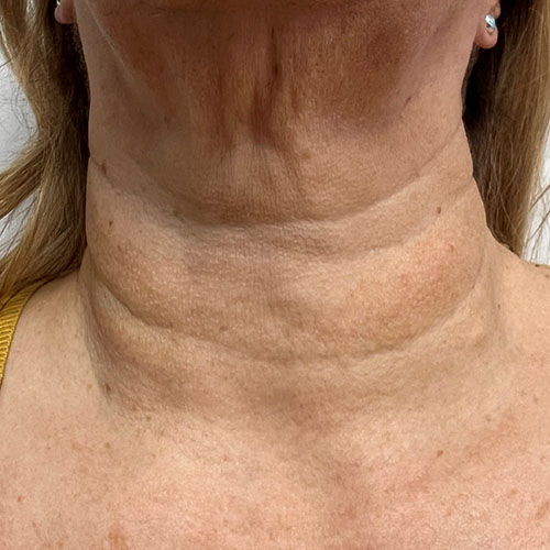 CoolVive vorher https://asclepion.com/cooltreatments/