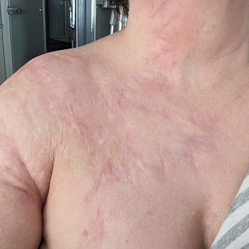 CoolYellow danach https://asclepion.com/cooltreatments/