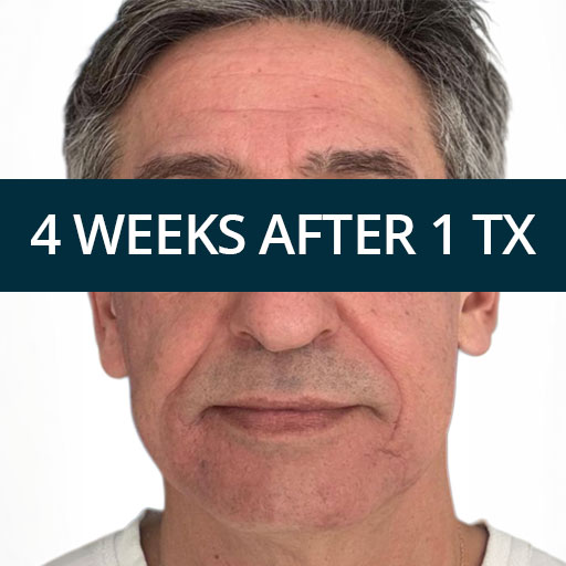 Deep Treatment B https://asclepion.com/deeprenew_de/