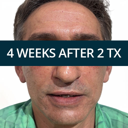 Deep Treatment C https://asclepion.com/deeprenew_de/