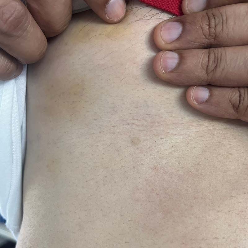 ASC Angiom Nachher https://asclepion.com/us/yellowstar_us/
