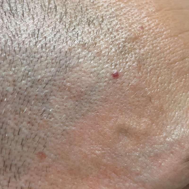 YellowStar_US 5 ASC Cherry Angioma vorher3 https://asclepion.com/us/yellowstar_us/