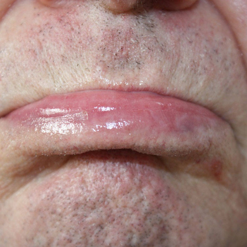 Cheilitis Actinica nachhe2r https://asclepion.com/multipulse-pro/