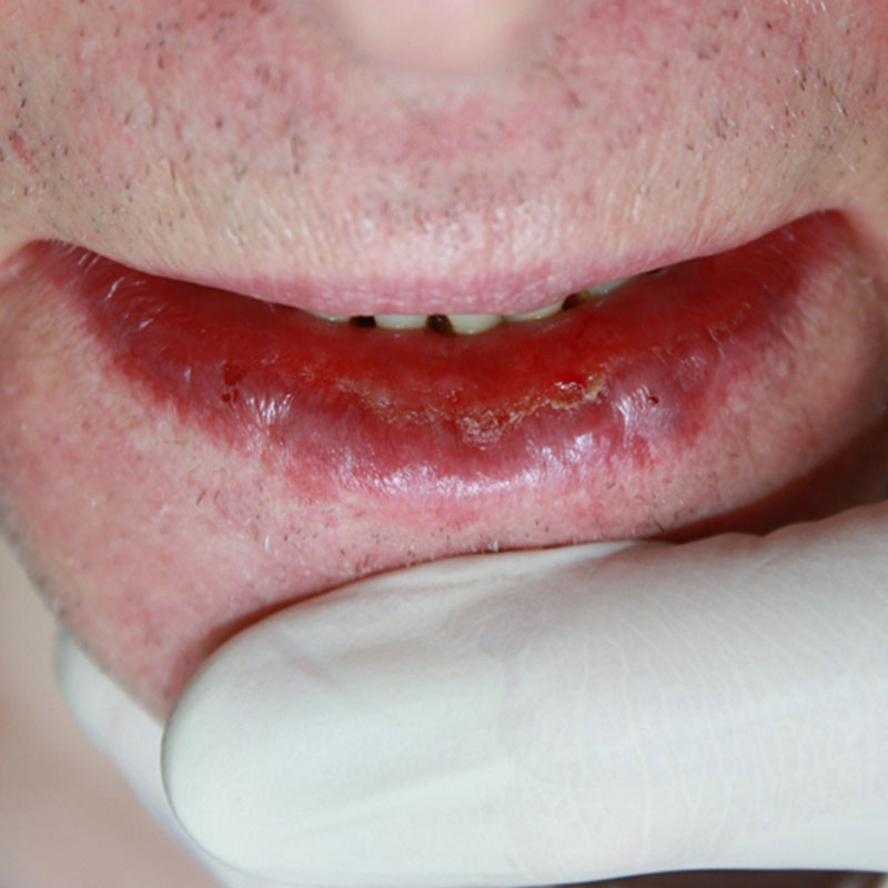 Cheilitis Actinica vorher https://asclepion.com/multipulse-pro/