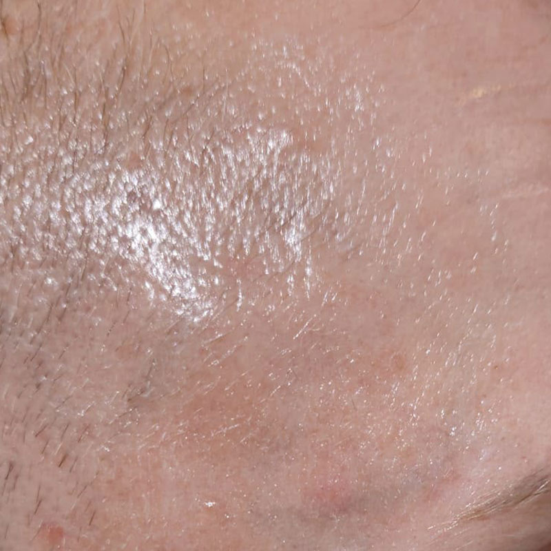 Cherry Angioma nachher3 https://asclepion.com/us/yellowstar_us/