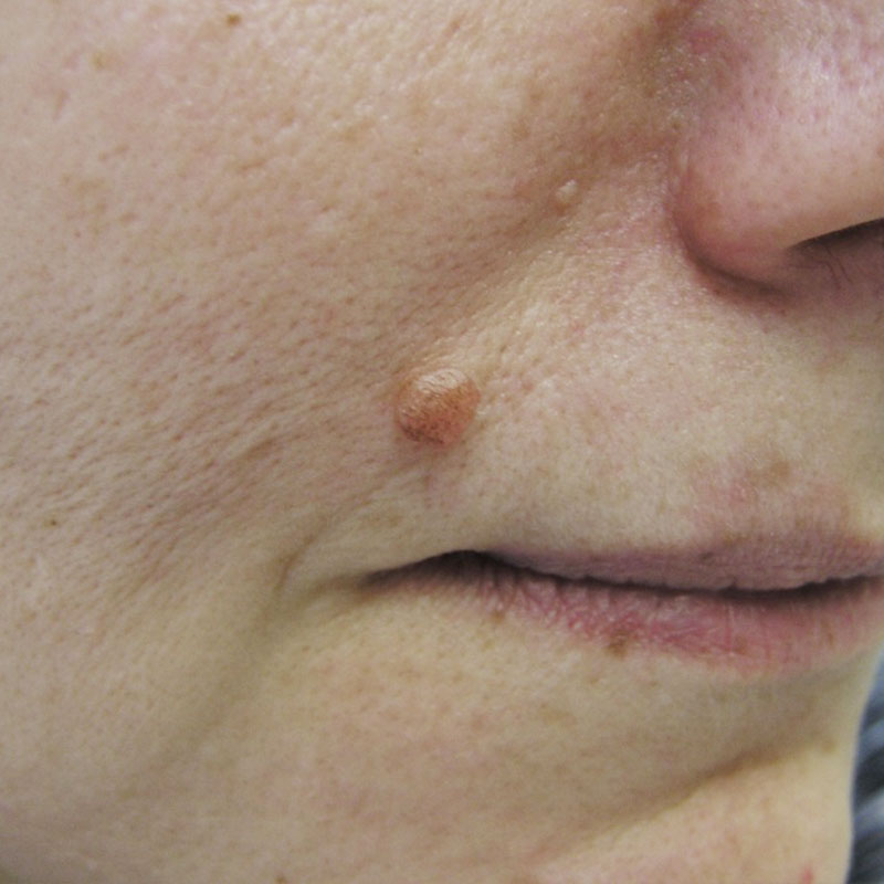 Naevuszellnaevus vorher https://asclepion.com/multipulse-pro/