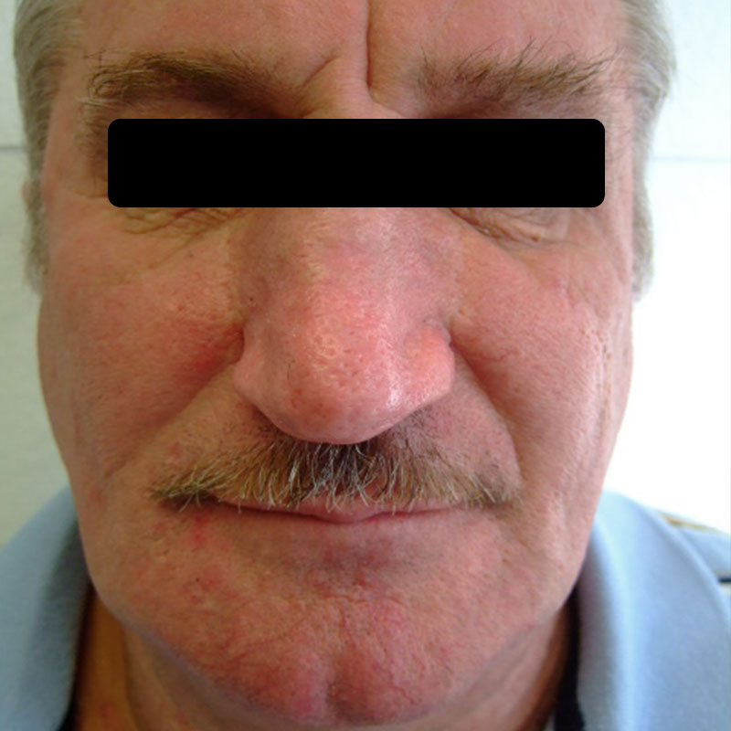 Rhinophym 7Wochen nach CO neu https://asclepion.com/multipulse-pro/