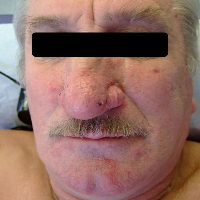 Rhinophym vor CO neu https://asclepion.com/multipulse-pro/
