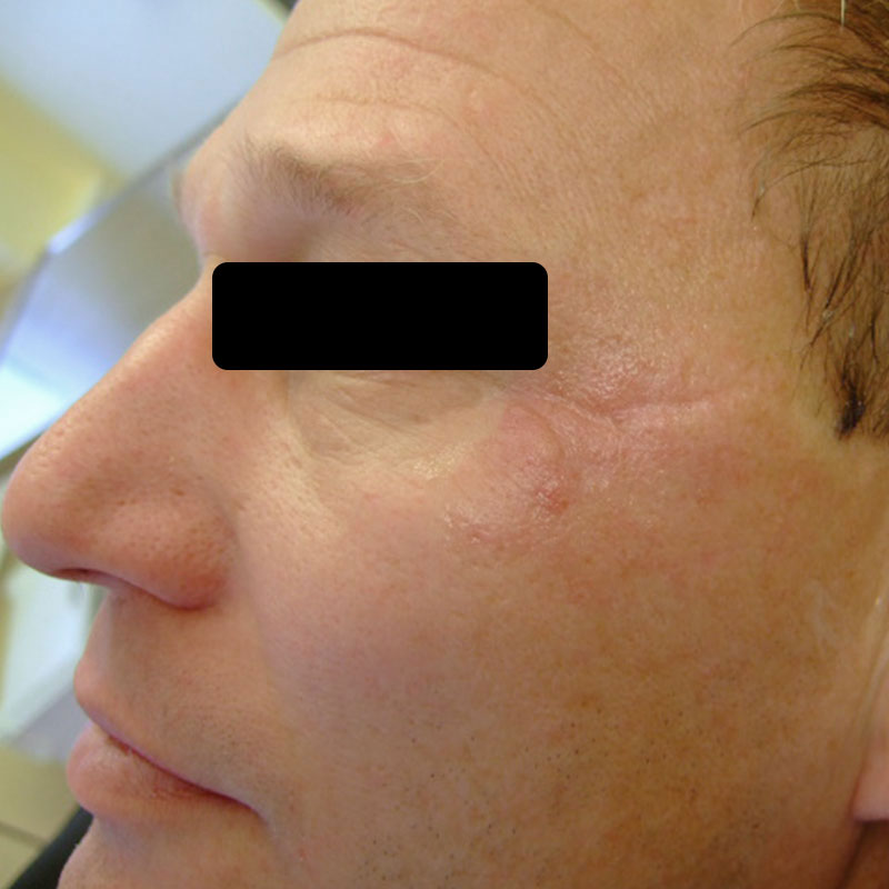 Unfallnarben vor frakt CO2 beh und nach Beh mit Kortisonunterspritzung neu https://asclepion.com/multipulse-pro/